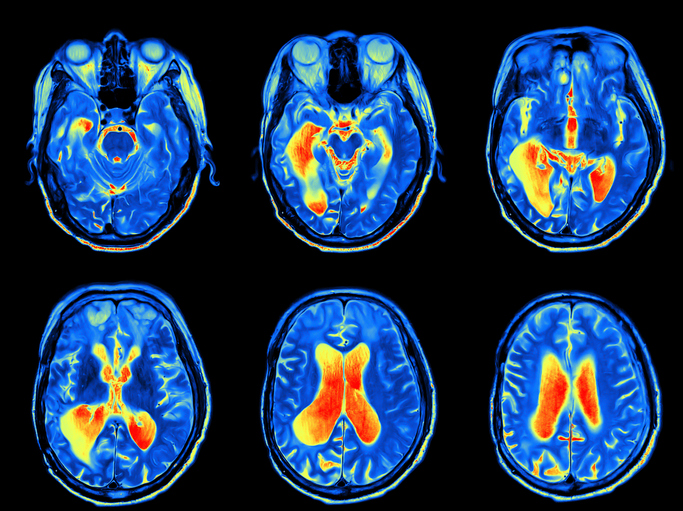MRI scan image of brain.